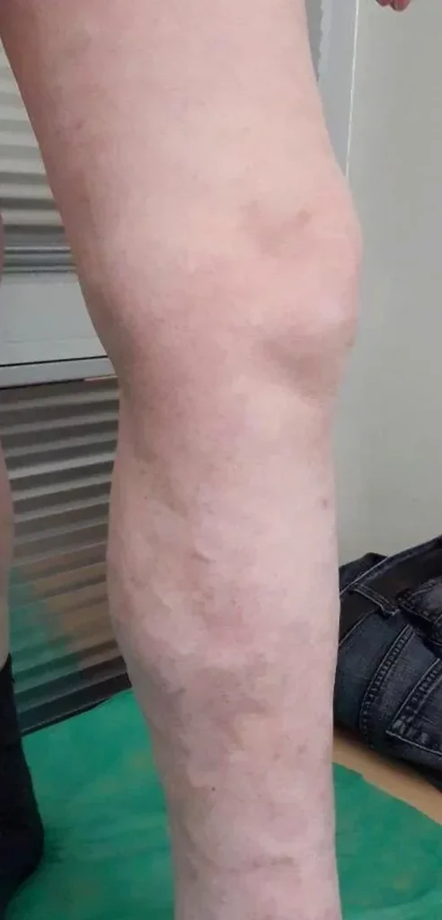 After treatment