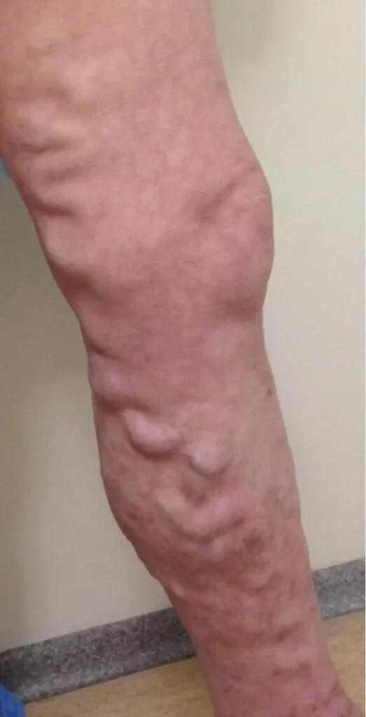 Before treatment
