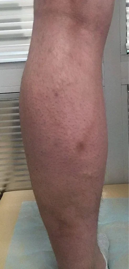 After treatment