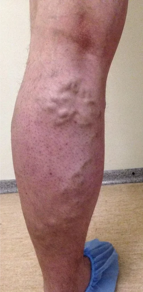 Before treatment