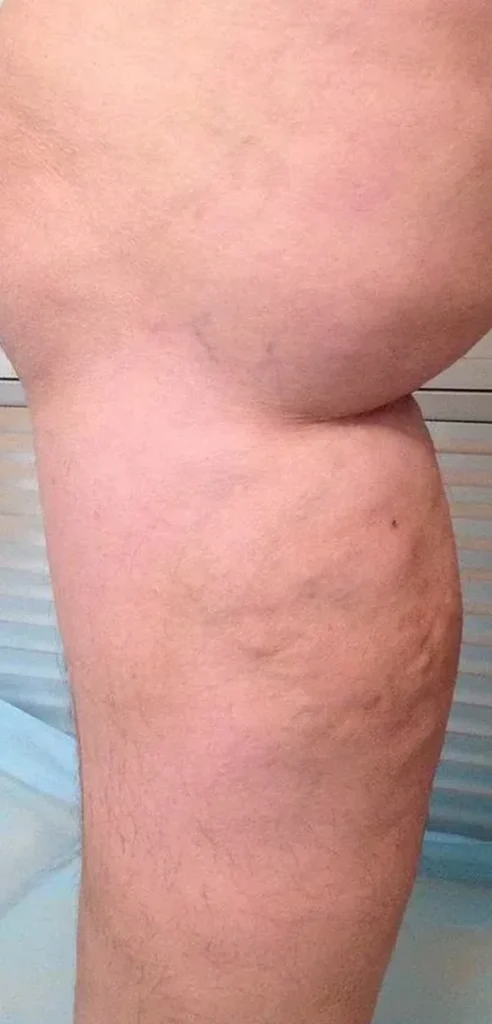 After treatment