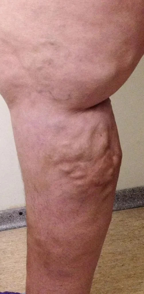 Before treatment