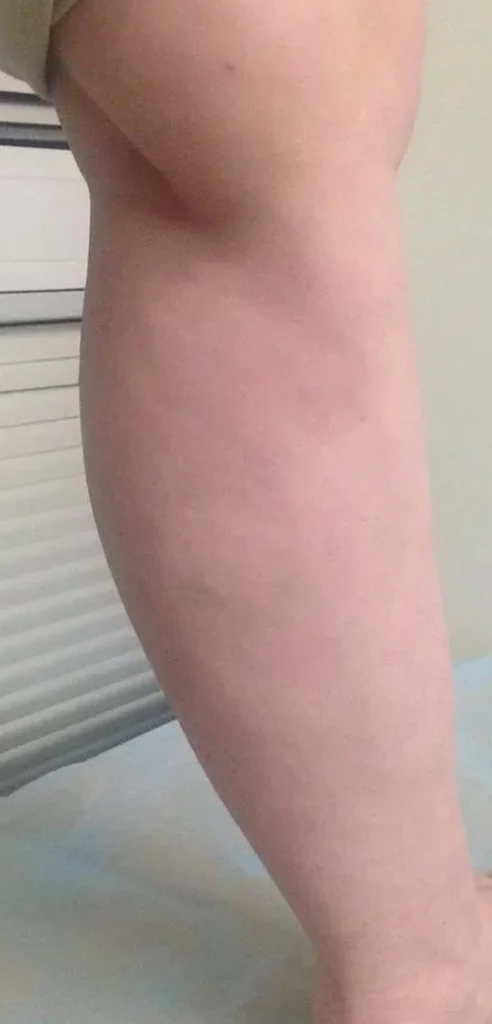 After treatment