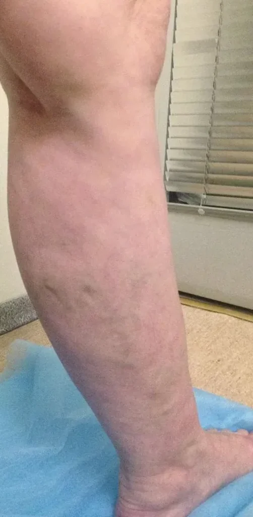 Before treatment