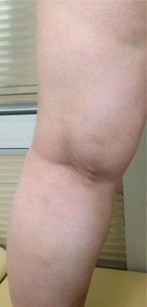 After treatment