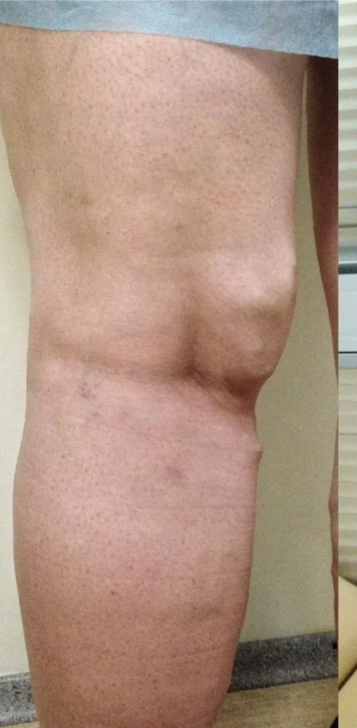 Before treatment